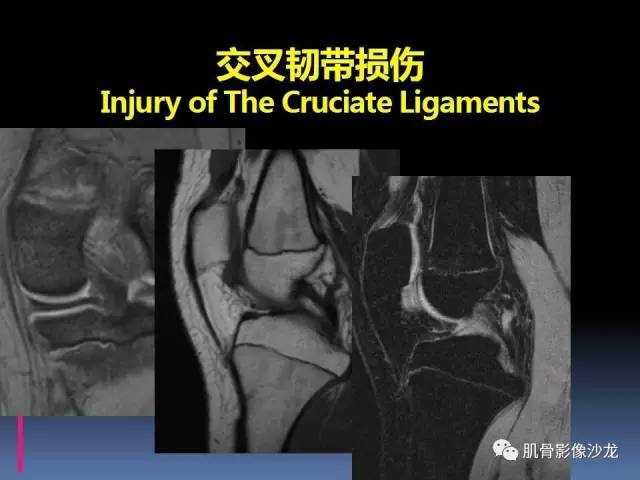 【PPT】膝关节病变影像学诊断