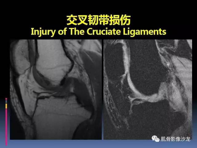 【PPT】膝关节病变影像学诊断