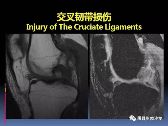 【PPT】膝关节病变影像学诊断