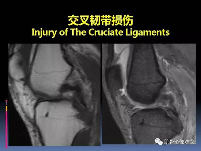 【PPT】膝关节病变影像学诊断