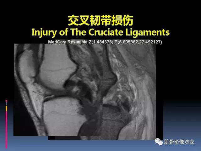 【PPT】膝关节病变影像学诊断