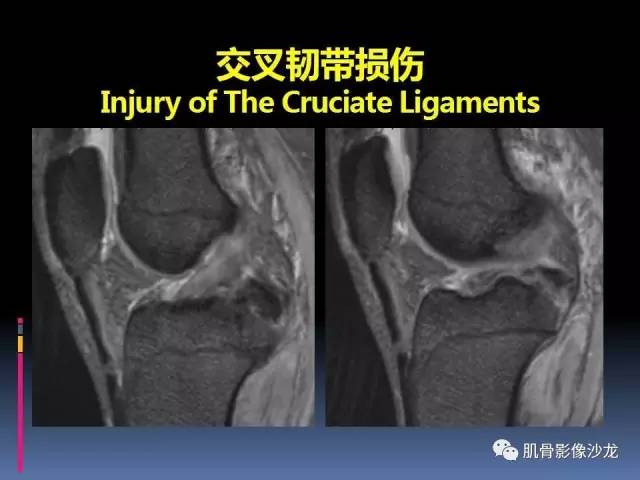 【PPT】膝关节病变影像学诊断