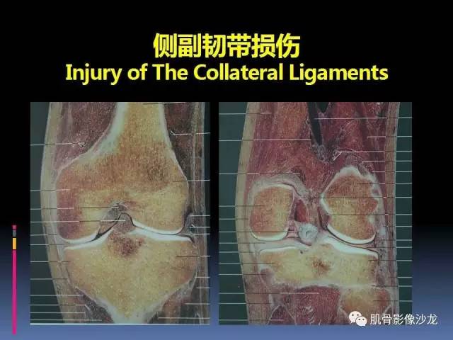 【PPT】膝关节病变影像学诊断