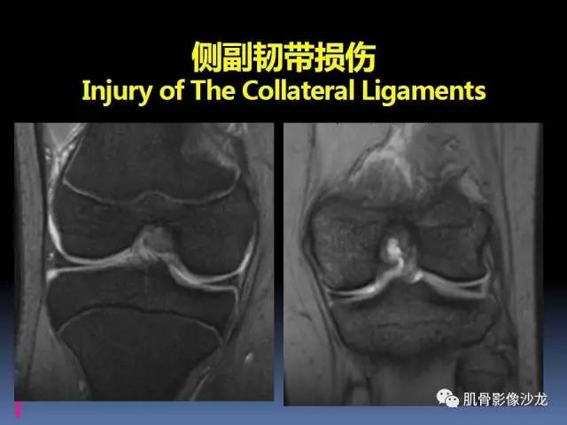 【PPT】膝关节病变影像学诊断