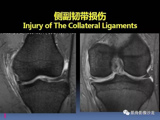 【PPT】膝关节病变影像学诊断