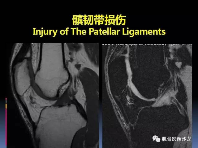 【PPT】膝关节病变影像学诊断