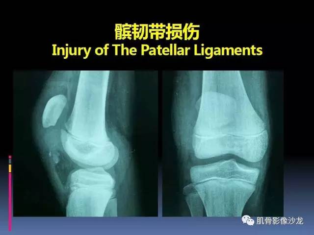 【PPT】膝关节病变影像学诊断