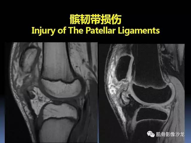 【PPT】膝关节病变影像学诊断