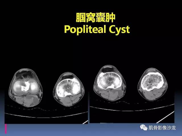 【PPT】膝关节病变影像学诊断