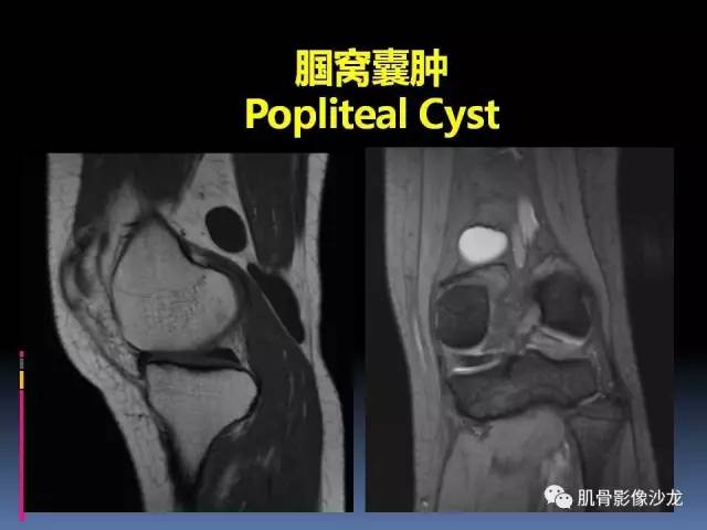 【PPT】膝关节病变影像学诊断