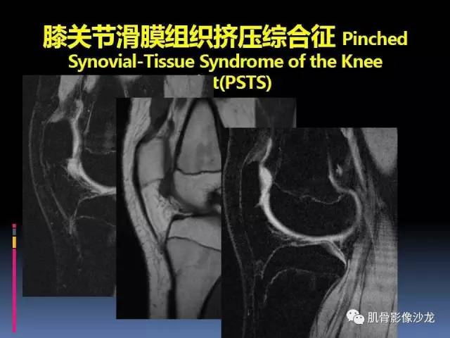 【PPT】膝关节病变影像学诊断