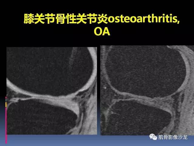 【PPT】膝关节病变影像学诊断