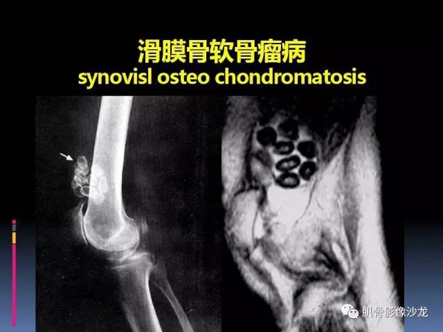 【PPT】膝关节病变影像学诊断