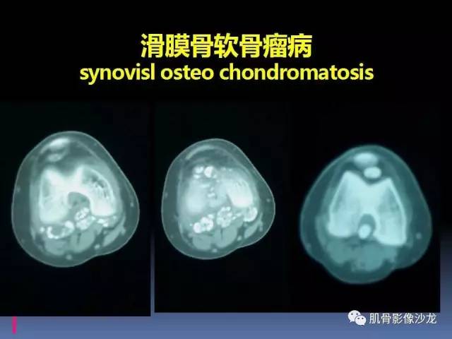 【PPT】膝关节病变影像学诊断