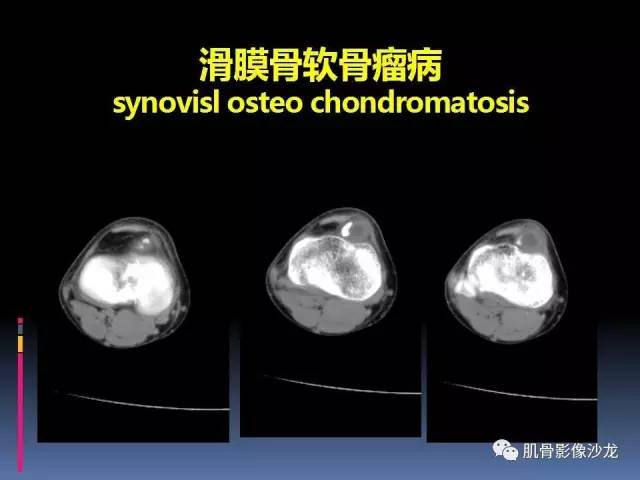 【PPT】膝关节病变影像学诊断