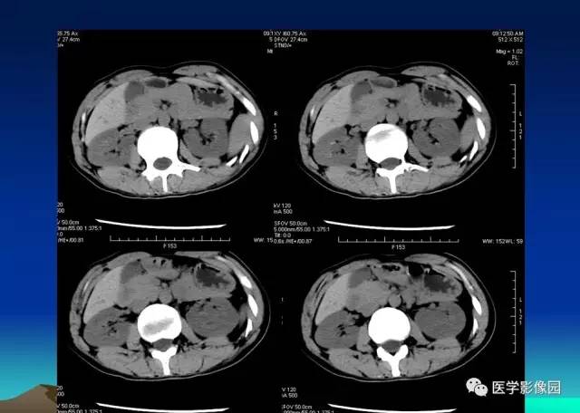 【病例】环状胰腺1例CT影像表现
