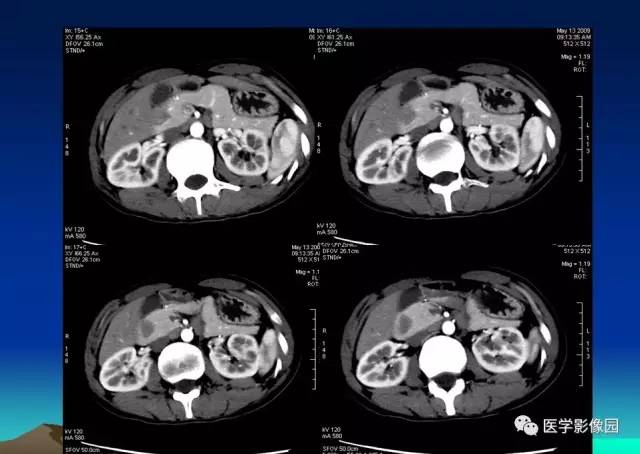 【病例】环状胰腺1例CT影像表现