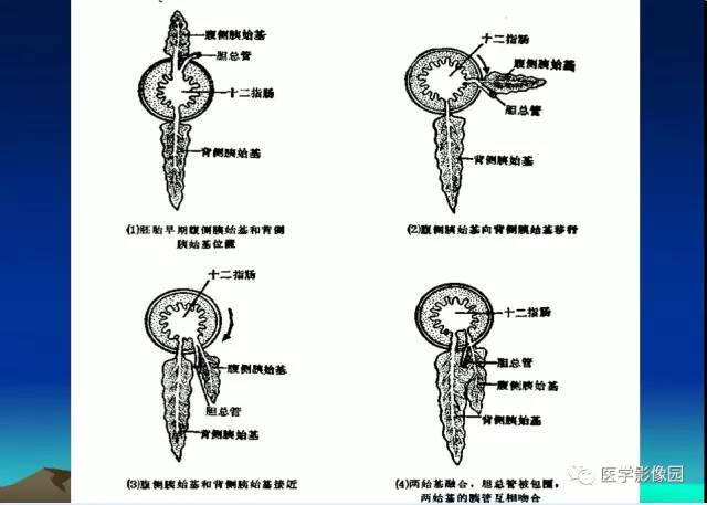 【病例】环状胰腺1例CT影像表现