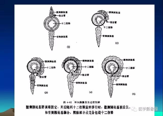 【病例】环状胰腺1例CT影像表现