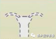 子宫发育异常,应想到的6大类常见畸形 子宫发育异常,应想到的6大类常见畸形