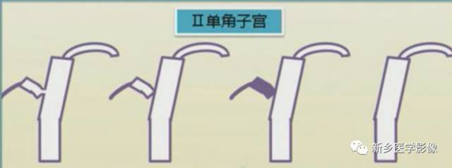 子宫发育异常,应想到的6大类常见畸形 子宫发育异常,应想到的6大类常见畸形