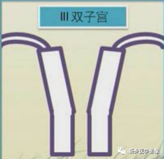 子宫发育异常,应想到的6大类常见畸形 子宫发育异常,应想到的6大类常见畸形