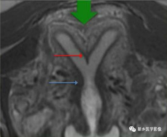 子宫发育异常,应想到的6大类常见畸形 子宫发育异常,应想到的6大类常见畸形