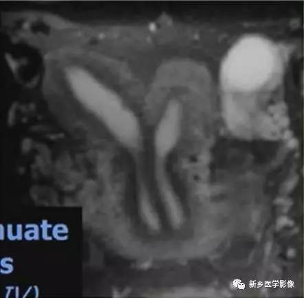 子宫发育异常,应想到的6大类常见畸形 子宫发育异常,应想到的6大类常见畸形
