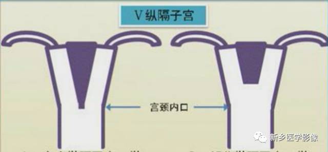 子宫发育异常,应想到的6大类常见畸形 子宫发育异常,应想到的6大类常见畸形