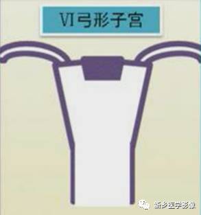 子宫发育异常,应想到的6大类常见畸形 子宫发育异常,应想到的6大类常见畸形