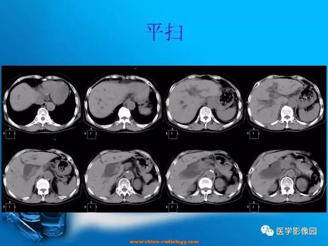 【病例】胆囊癌1例CT影像表现 【病例】胆囊癌1例CT影像表现