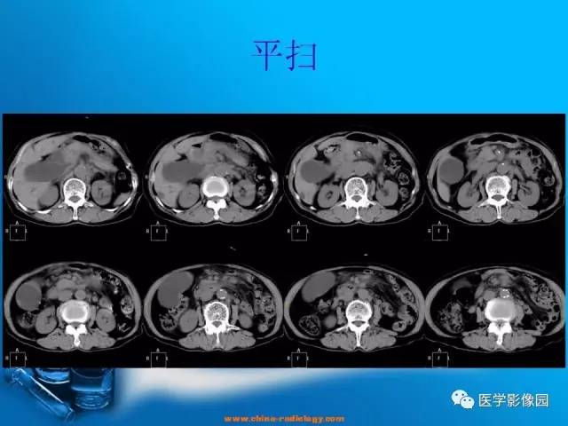 【病例】胆囊癌1例CT影像表现 【病例】胆囊癌1例CT影像表现