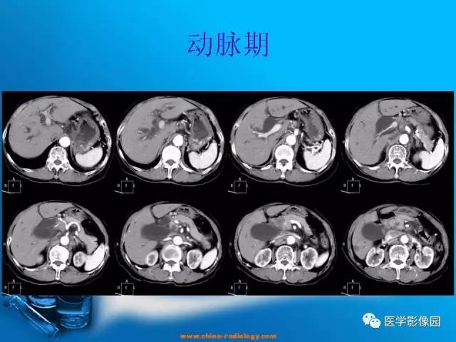 【病例】胆囊癌1例CT影像表现 【病例】胆囊癌1例CT影像表现