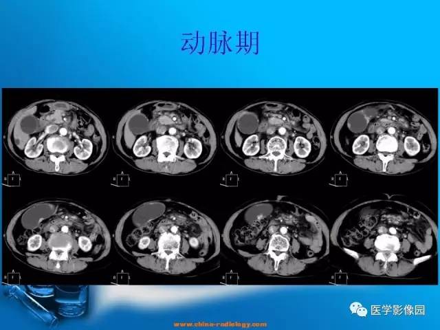 【病例】胆囊癌1例CT影像表现 【病例】胆囊癌1例CT影像表现