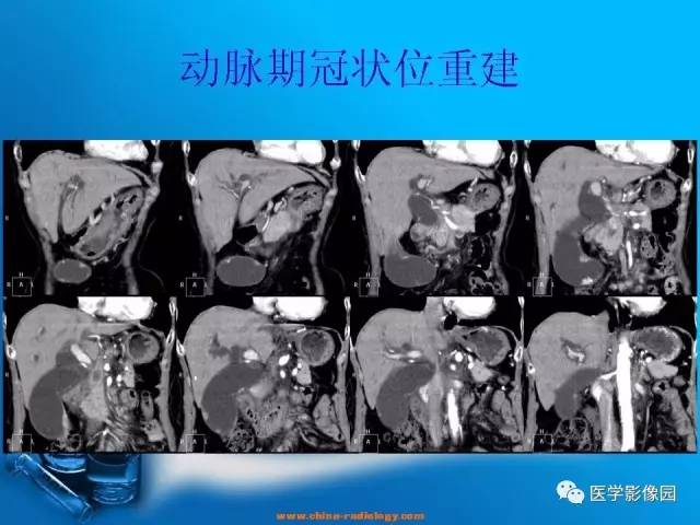 【病例】胆囊癌1例CT影像表现 【病例】胆囊癌1例CT影像表现