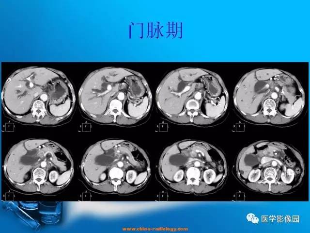 【病例】胆囊癌1例CT影像表现 【病例】胆囊癌1例CT影像表现