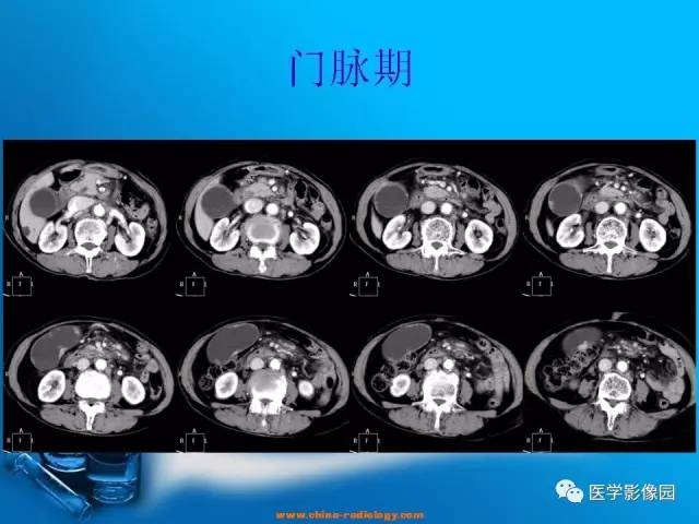 【病例】胆囊癌1例CT影像表现 【病例】胆囊癌1例CT影像表现