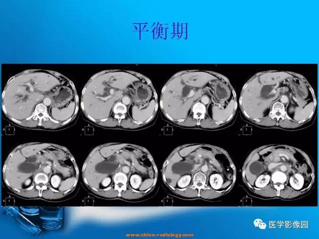 【病例】胆囊癌1例CT影像表现 【病例】胆囊癌1例CT影像表现