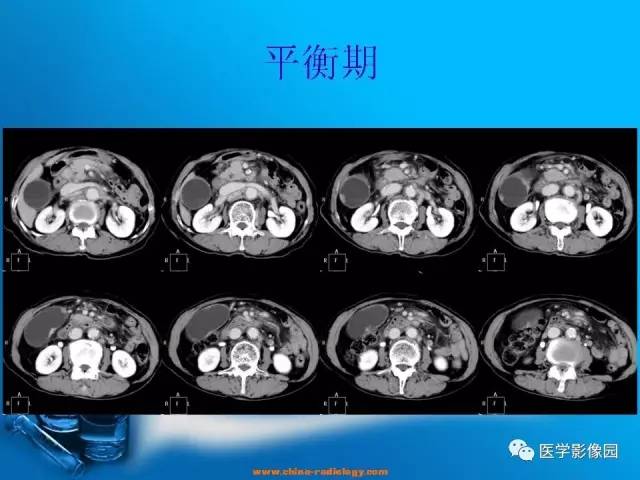 【病例】胆囊癌1例CT影像表现 【病例】胆囊癌1例CT影像表现