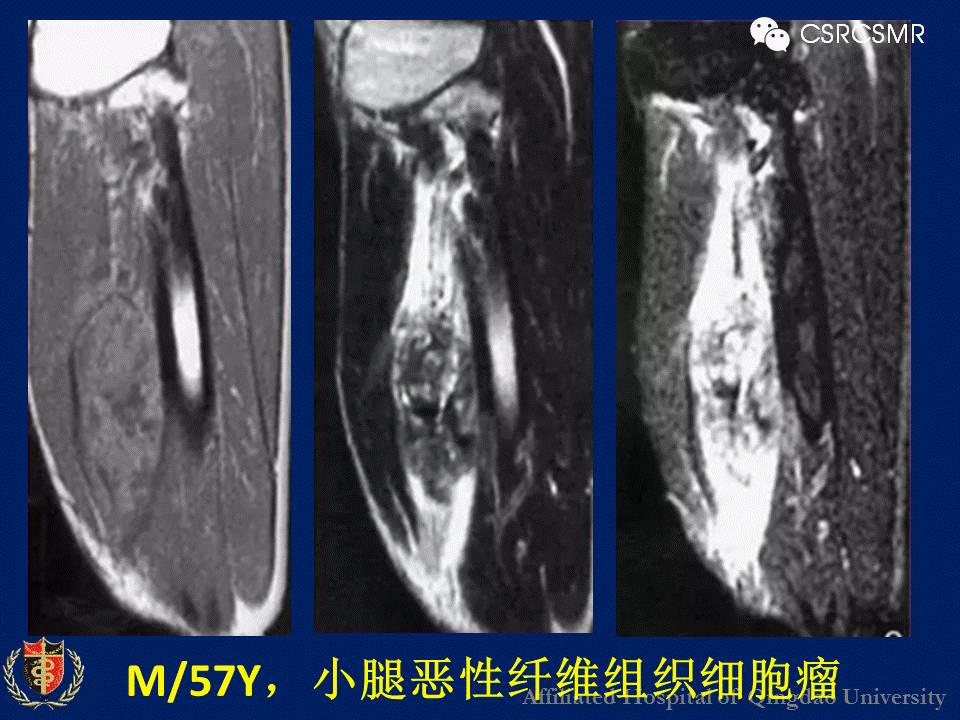 【PPT】软组织肿瘤影像学诊断价值