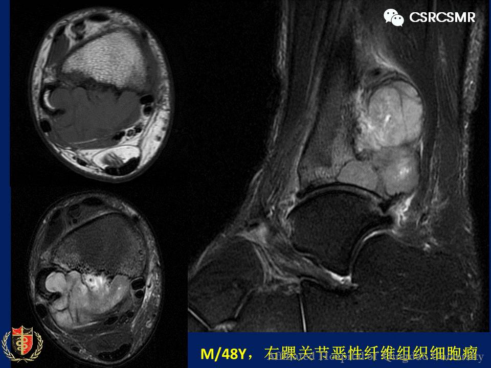 【PPT】软组织肿瘤影像学诊断价值