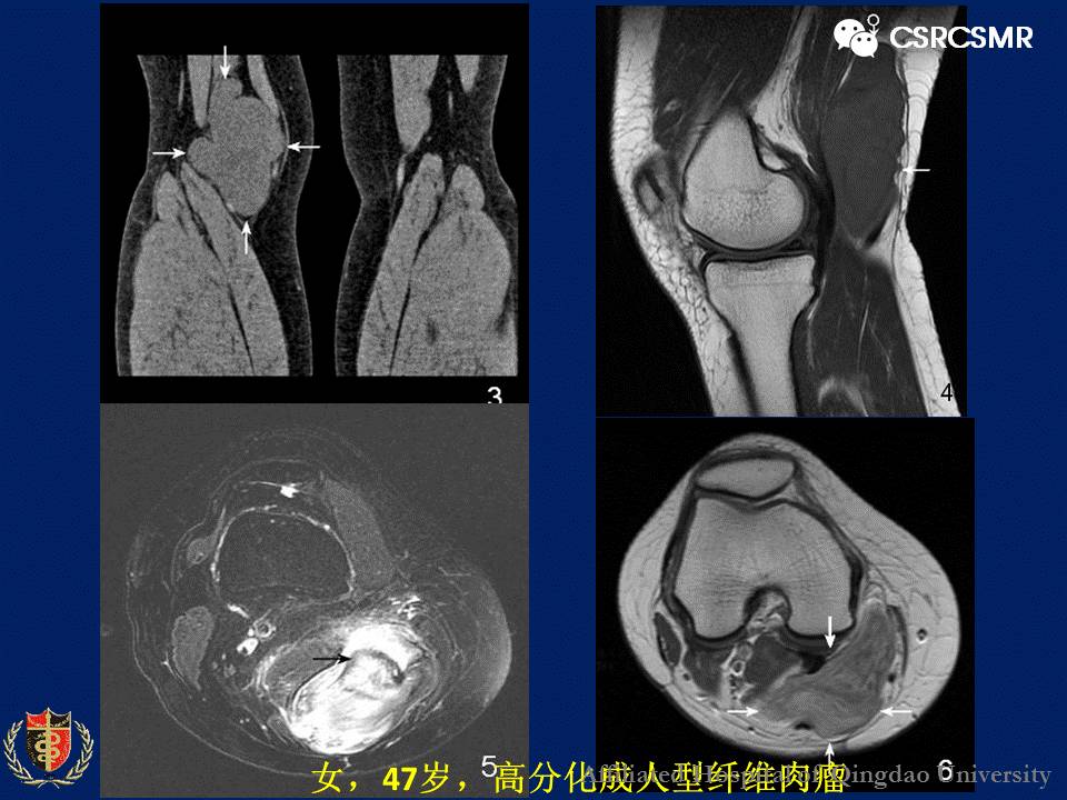 【PPT】软组织肿瘤影像学诊断价值