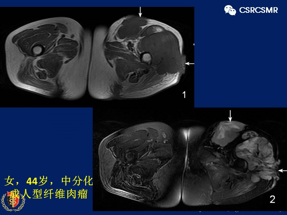 【PPT】软组织肿瘤影像学诊断价值