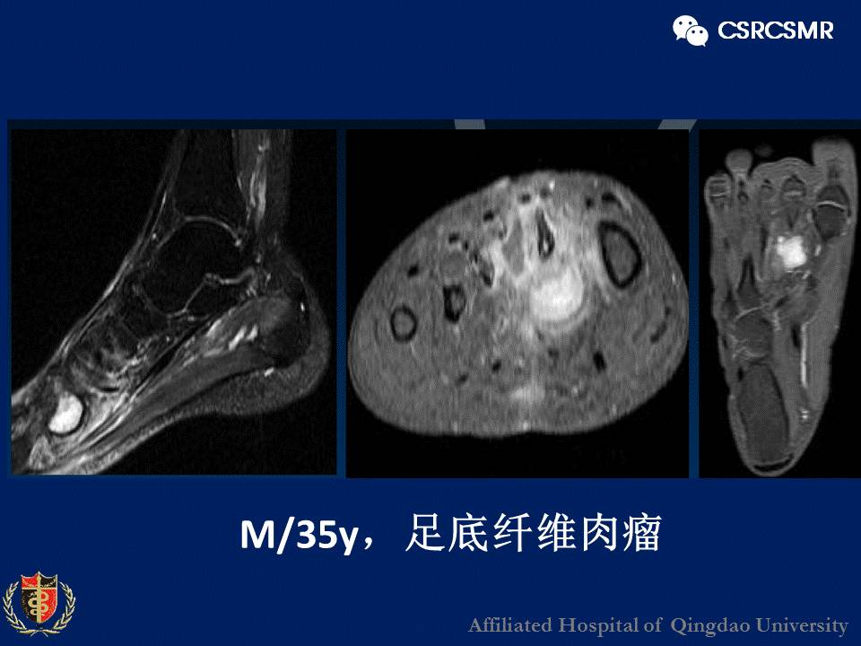 【PPT】软组织肿瘤影像学诊断价值