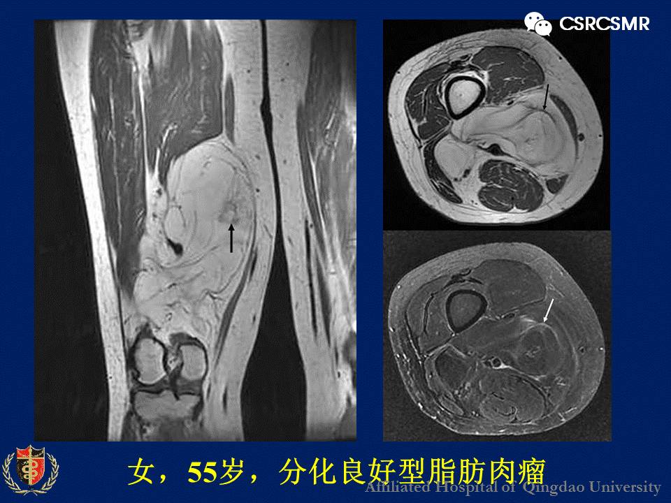 【PPT】软组织肿瘤影像学诊断价值