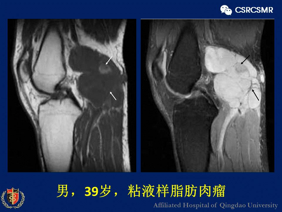 【PPT】软组织肿瘤影像学诊断价值