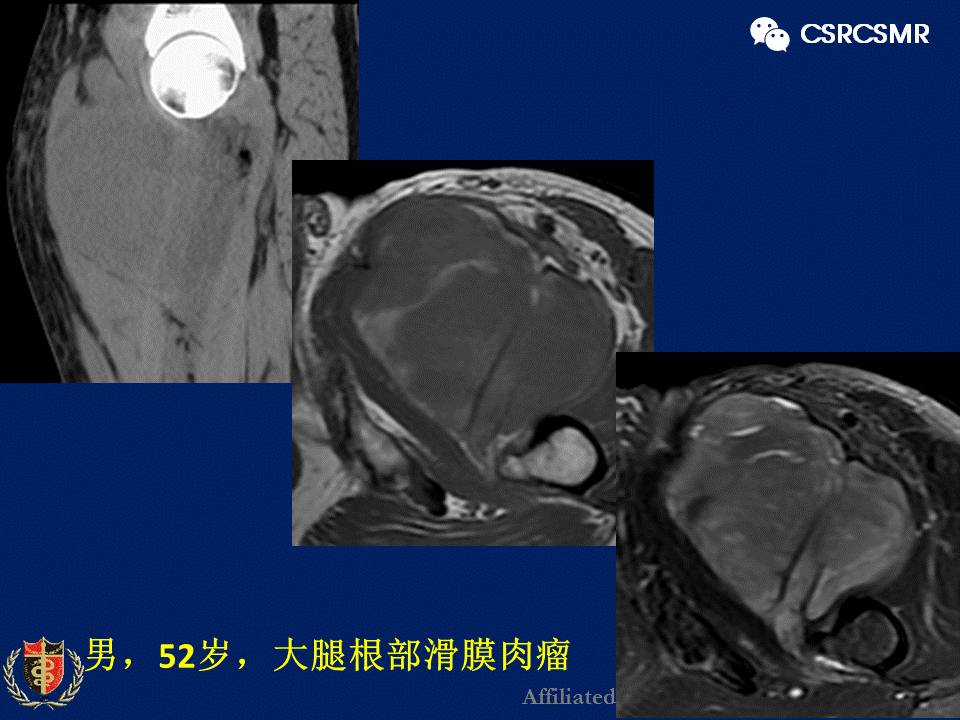 【PPT】软组织肿瘤影像学诊断价值