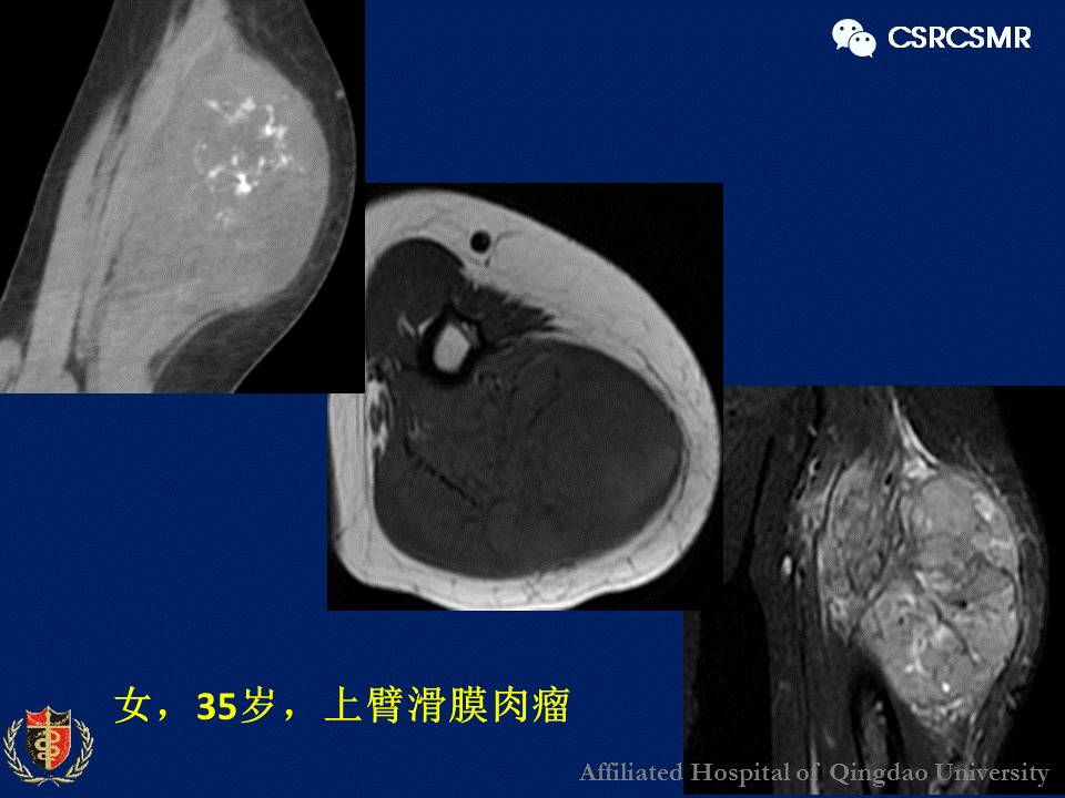 【PPT】软组织肿瘤影像学诊断价值