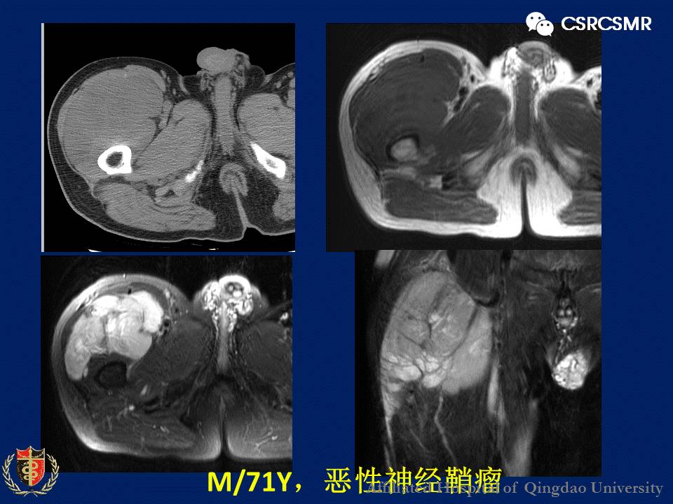 【PPT】软组织肿瘤影像学诊断价值