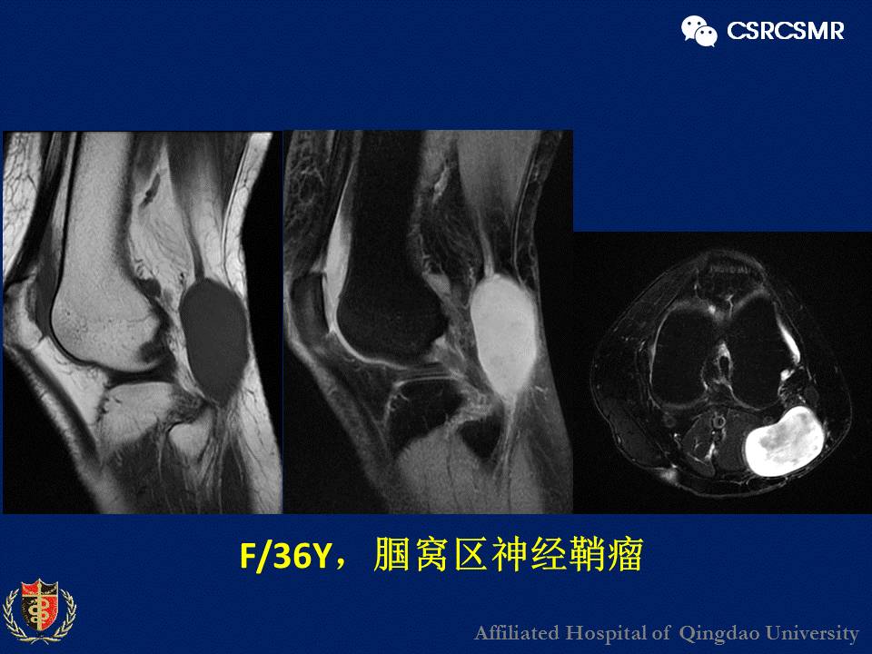 【PPT】软组织肿瘤影像学诊断价值